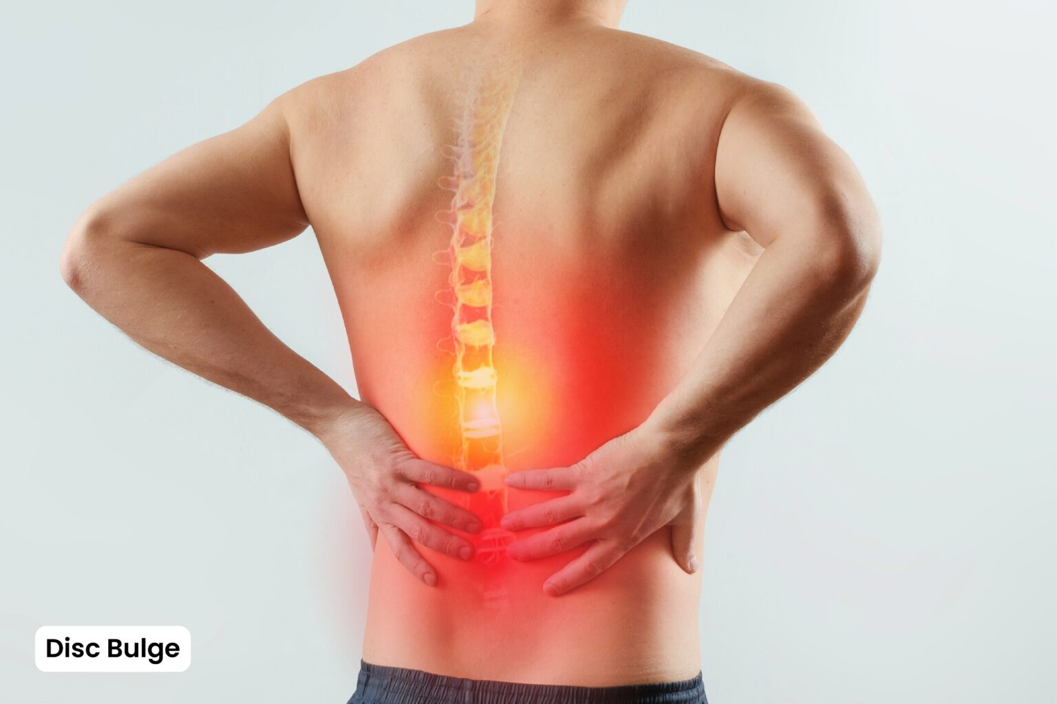 Slip Disc Physiotherapy Treatment in Delhi